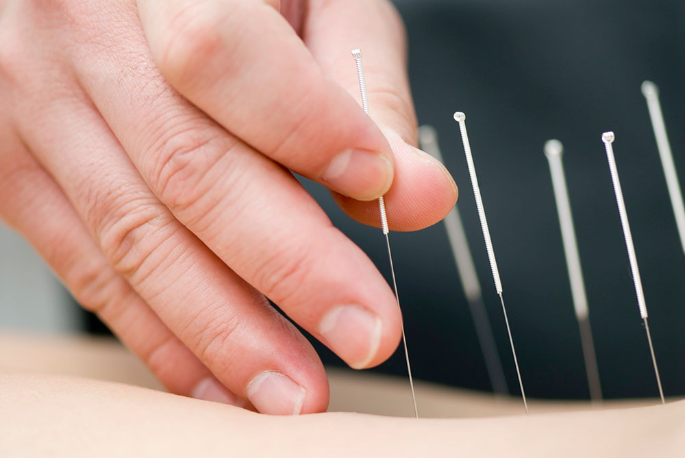 Acupuncture Clinic in Cochrane, Alberta